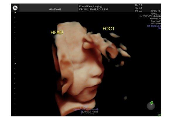 5D/HD ultrasound