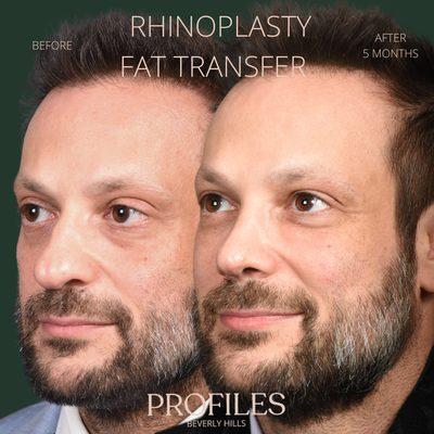 Rhinoplasty + Fat Transfer