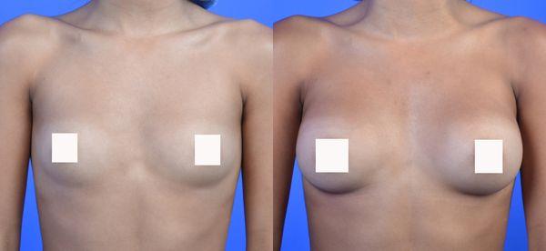 Breast Augmentation