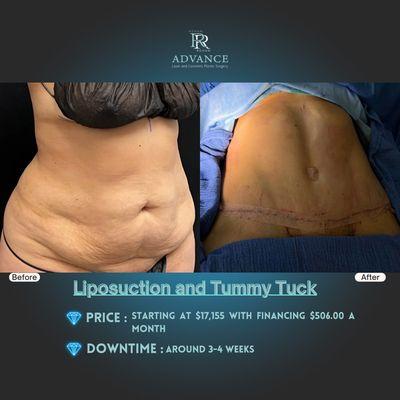 Tummy Tuck and Contoured Liposuction