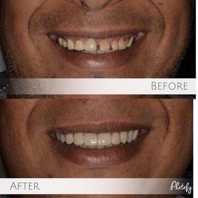 One of our completed smile makeovers