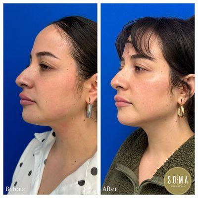 After 1 vial of Kybella. Kybella is an injectable treatment to improve the appearance of fat underneath the chin.