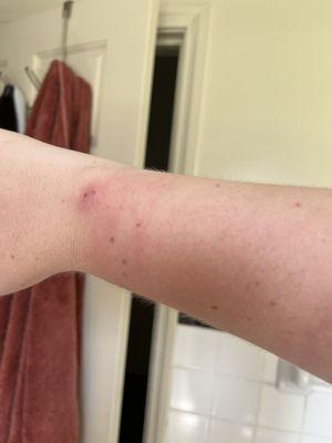 puncture wound on wrist, bit through skin