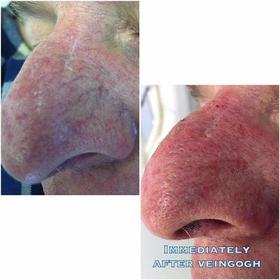 Nasal and facial veins are permanently treated using the VeinGogh. Mild inflammation post treatment quickly subsides.