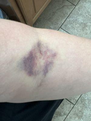 How a female left my arm which in turn left me unable to donate for a week causing me to miss the promotion