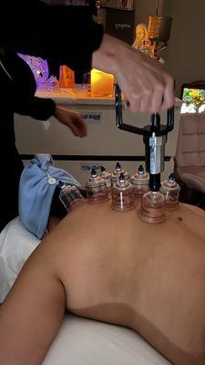 Cupping treatment