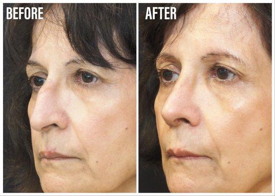 Rhinoplasty