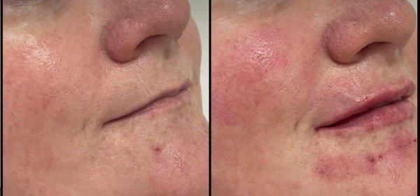 Laser facial to address sunspots and rosacia. And best of all, new lips !