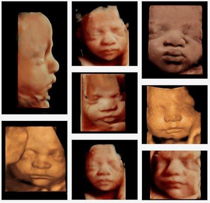 Did you know there is a difference between 3D4D Ultrasound and HD Live Ultrasound?