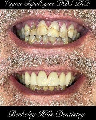 Six Front Veneers