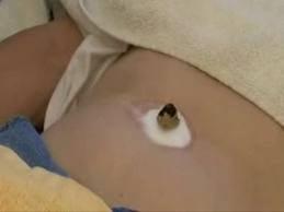 Moxibustion