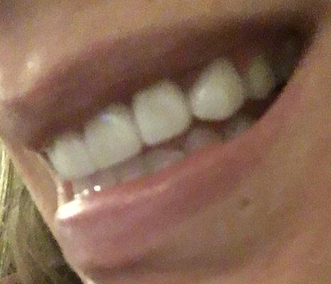 Permanent veneers left side