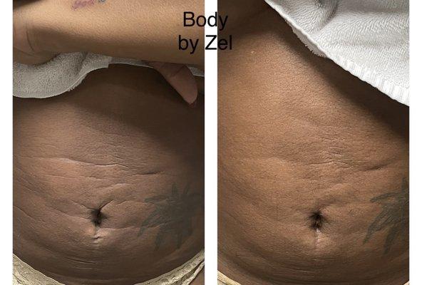 Lymphatic massage for drainage and scar tissue and after tummy tuck.