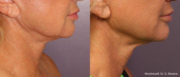 Jowls are skin laxity from loss of collagen. At Redefyne MD, come experience the magic of Morpheus 8 to get rid of those jowls.