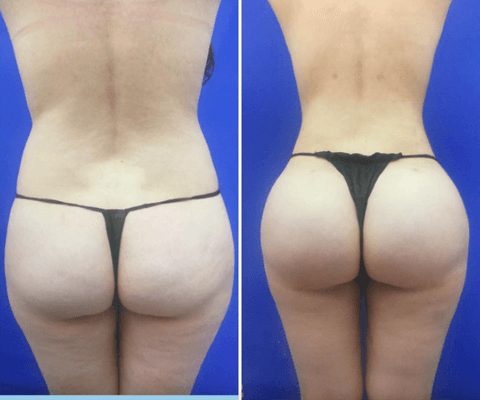 BBL (Brazilian Butt Lift)