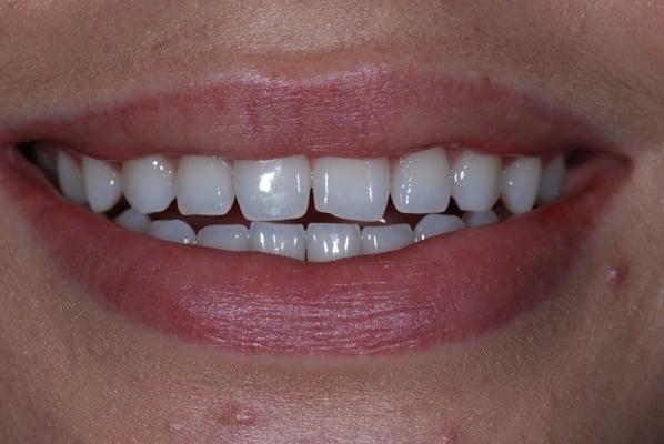 Before Dental Makeover -A