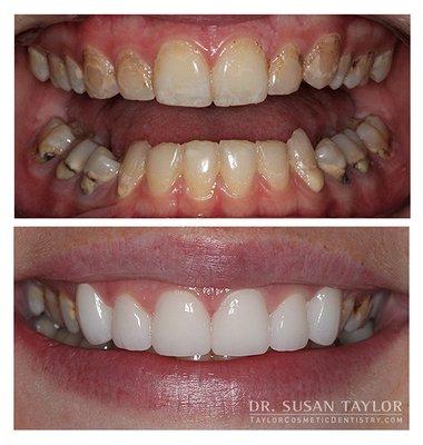 Before & After: Custom Porcelain Veneers. Actual patient of Dr Susan Taylor