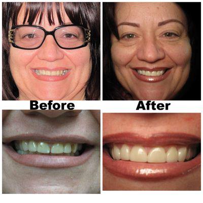 Suzan with10 upper veneers after Invisalign.
 Stunning smile