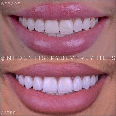 Veneers