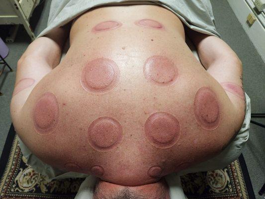 Cupping