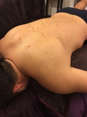 The dry needles (acupuncture needles) can be placed anywhere along lines of fascia to relieve pain