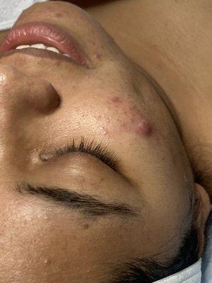 Acne Facial - After photo