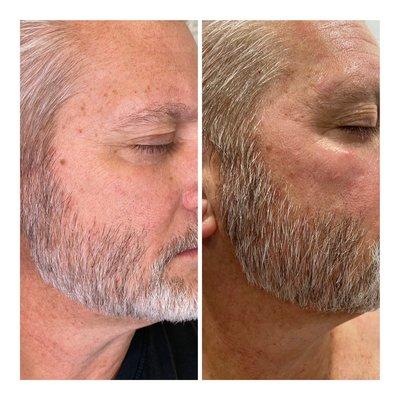 Before and after one facial treatment.