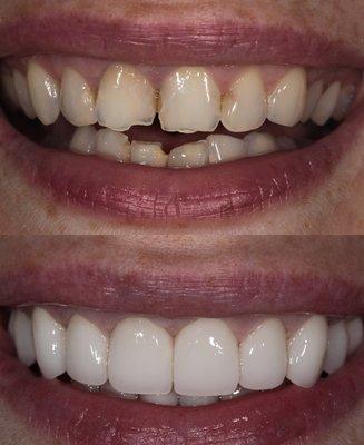 Dental Crowns Teeth #5-12