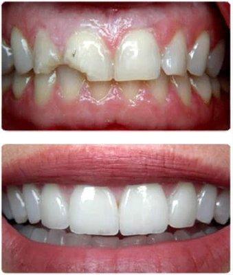 Broken Teeth Before-After