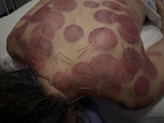 Acupuncture after cupping