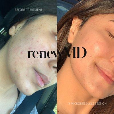 Microneedling treatment