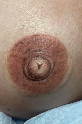 3D areola tattoo for cancer survivor