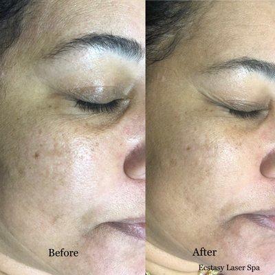 MicroNeedling with Hydrofacial