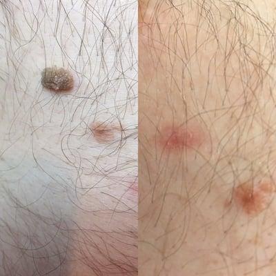 Treatment of a large keratosis on chest area. After picture is 2 weeks later