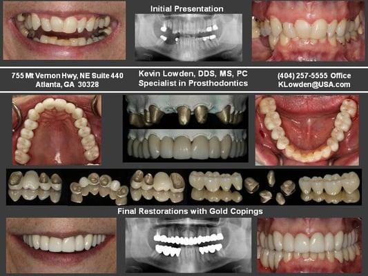 3/4 Full Mouth Rehabilitation
 Sjogren's Syndrome Treatment Alternative
 Discover Your Options with a Specialist in Prosthodontics