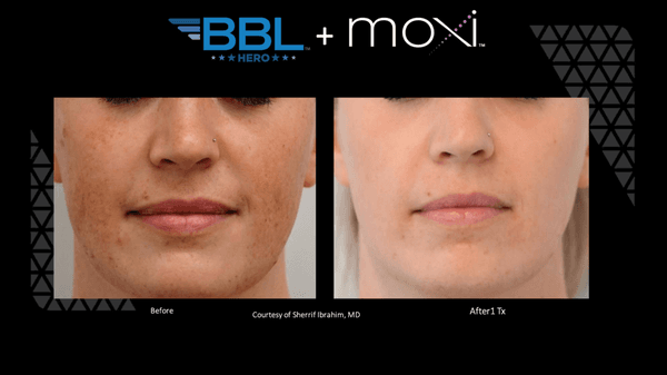 Our Signature Laser Treatment - BBL + Moxi Corrects Sundamage, Hyperpigmentation + Reduces Fine Lines!  Call 661-259-8100 For A Free Consult