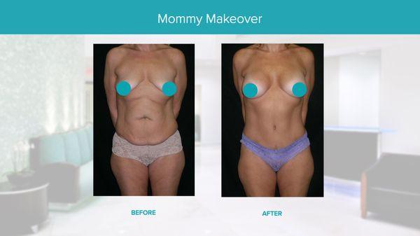 Real Results Before & After-Mommy Makeover