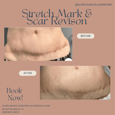 Inkless Stretch Mark and Scar Revision