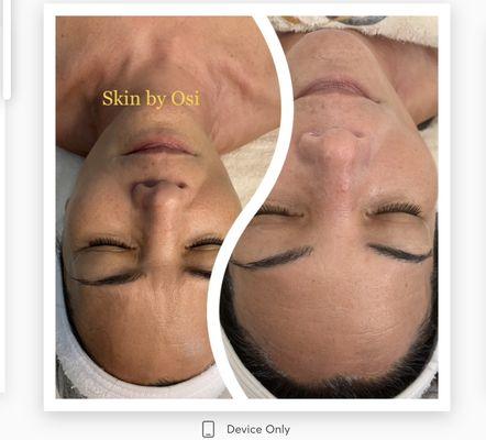 B/A Lift & Firm Single Treatment