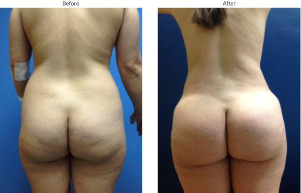 VASER Lipo with Brazilian Butt Lift. Just one session