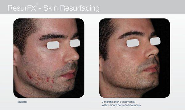 W8MD medspa laser skin resurfacing for any scars including acne scars