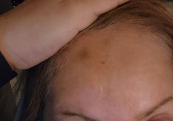 Bruising for the first time, and I've gotten botox many times.