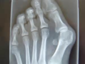 Bunions are a bone deformities that require treatment. Relief is available to treat the pain & pressure. Call us for more info.