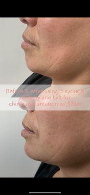 Chin augmentation done using 1 syringe of Restylane Lyft fillers.