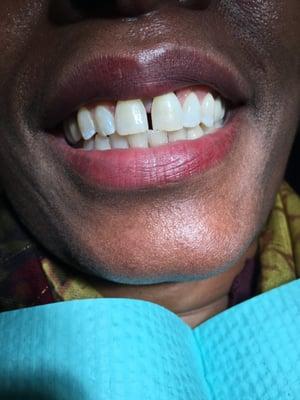 patient wanted to know what could be done with her gap