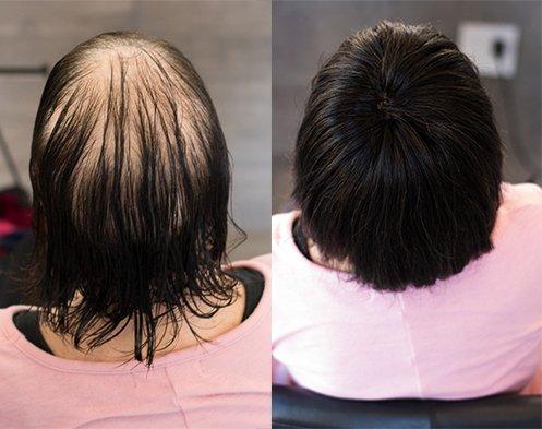 Our Crown Fusion Hair Extensions are for women suffering from thinning and balding at the top of the scalp.