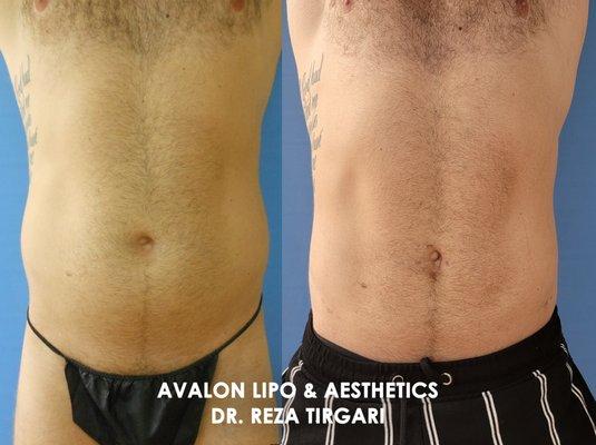 Before & After Liposuction with Dr. Tirgari - www.lipoandaesthetics.com - Abdomen