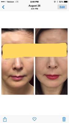 Facial Lifting Before and After