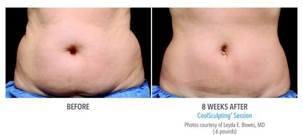 25% OFF CoolSculpting for mentioning this ad!