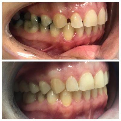 Before and after Invisalign treatment and crowns/white fillings on her back teeth.